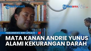 Kondisi Terkini Andrie Yunus di RSCM, Mata Kanan Alami Iskemia dan Penipisan Kornea