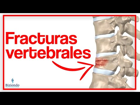 😖 Aplastamiento de vertebras en la columna: ¿Qué son? ¿Cómo tratarlos? | Biziondo