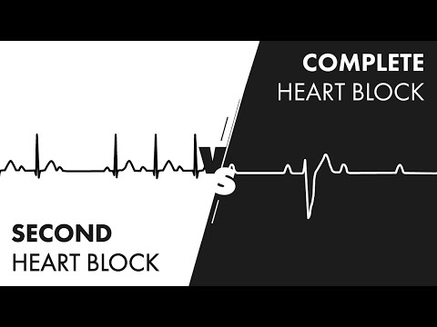 Second vs Third Degree Heart Block - MEDZCOOL