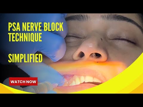PSA Nerve Block Simplified