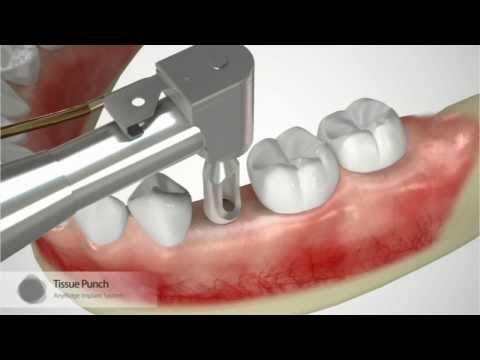 patiënt informatie: Hoe wordt er geïmplanteerd
