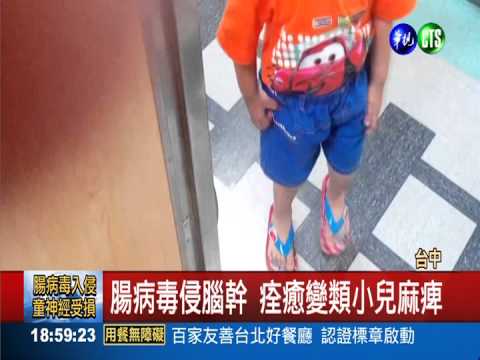 腸病毒侵腦 病童四肢無力需復健