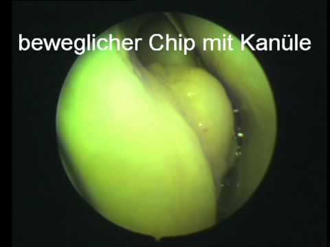 Schmerzen bei 39 Wochen der Schwangerschaft Betriebsverfahren auf das Hüftgelenk