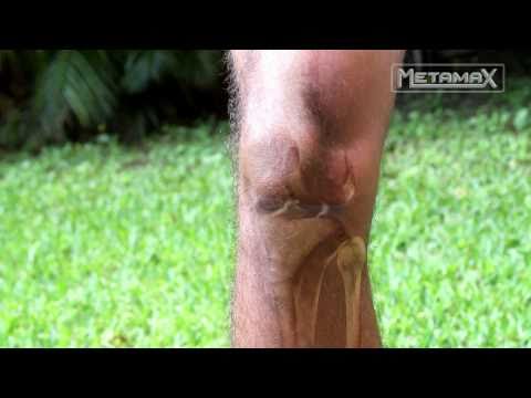 Cat dureaza inflamatia genunchiului