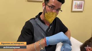 Tratamiento de Otoplastia con Hilos Tensores