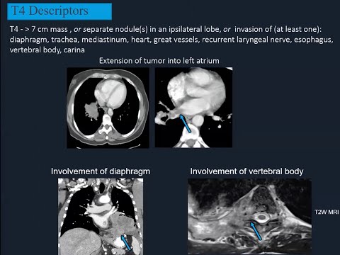 Lung cancer staging SCII Dr Asha Kandathil