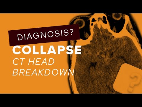 CT head breakdown: a guide to subarachnoid haemorrhage