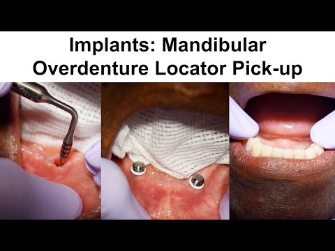 Implants: Mandibular Overdenture Locator Pick-up
