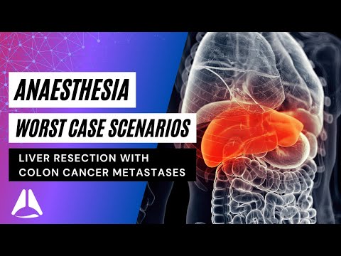 Liver Resection for Colon Cancer Mets | Worst Case Scenarios | #anesthesia #anaesthesia #exam