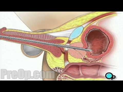 Recupero dopo biopsia prostatica Herpes conseguenza di prostatite