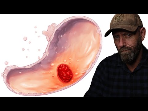 Alcohol Stomach Cancer Risks - Wine vs. Beer vs. Spirits - Does the Type of Alcohol Matter?