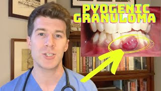 How to recognise and treat a Pyogenic Granuloma | Doctor O