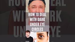 How to Get Rid of Dark Circles Fast!