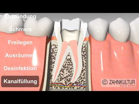 Wie läuft eine Wurzelkanalbehandlung ab? - Wurzelbehandlung beim Zahnarzt -
