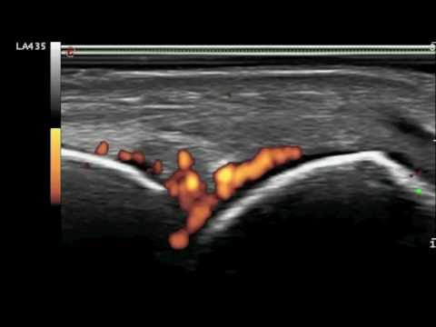 Trattamento displasia congenita dellanca Gonfiore sotto gli occhi con osteocondrosi cervicale