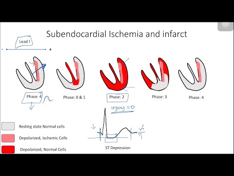 ST Elevation and Depression: Electrophysiological Basis