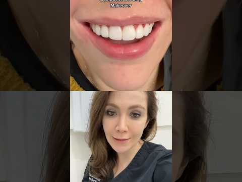 Fixing The Length Of Front Teeth!