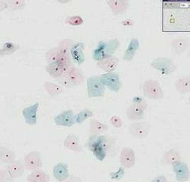 Histopathology Cervix--Low grade squamous intraepithelial le