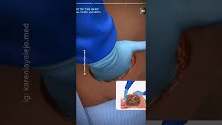 Download lagu Proses Operasi Caesar mp3