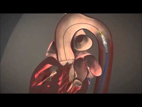 TF Procedure（TAVI 経大腿アプローチ）