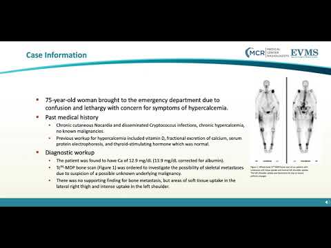 Thumbnail image of video presentation for Extraosseous Soft Tissue Uptake on Tc99-MDP Bone Scans: Case and Review (Theodore Hagens, BS, Abigail Winz, MD, Kathy Byun, MD - Department of Radiology)