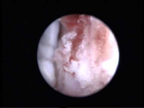 Расслаивающий остеохондрит медиального мыщелка бедра