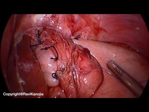 Toupet Fundoplication (Posterior Wrap)