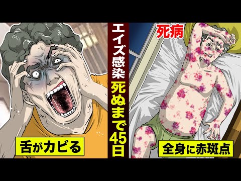 HIV-ヒューマン免疫ウイルス