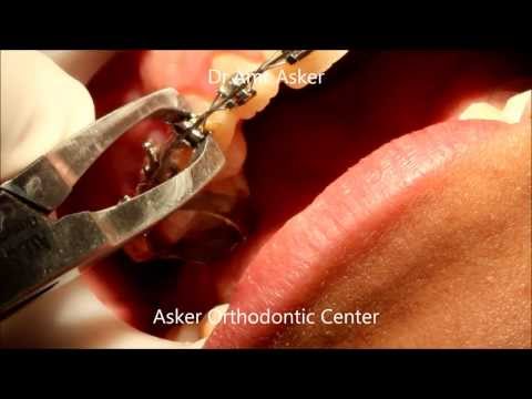 Usunięcie aparatu ortodontycznego