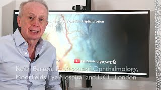 Recurrent Carlevale Haptic IOL Erosion