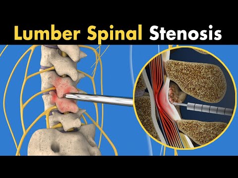 MILD procedure of lumber spinal stenosis (3D animation)