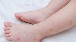 How to Treat Flea Bites on Babies