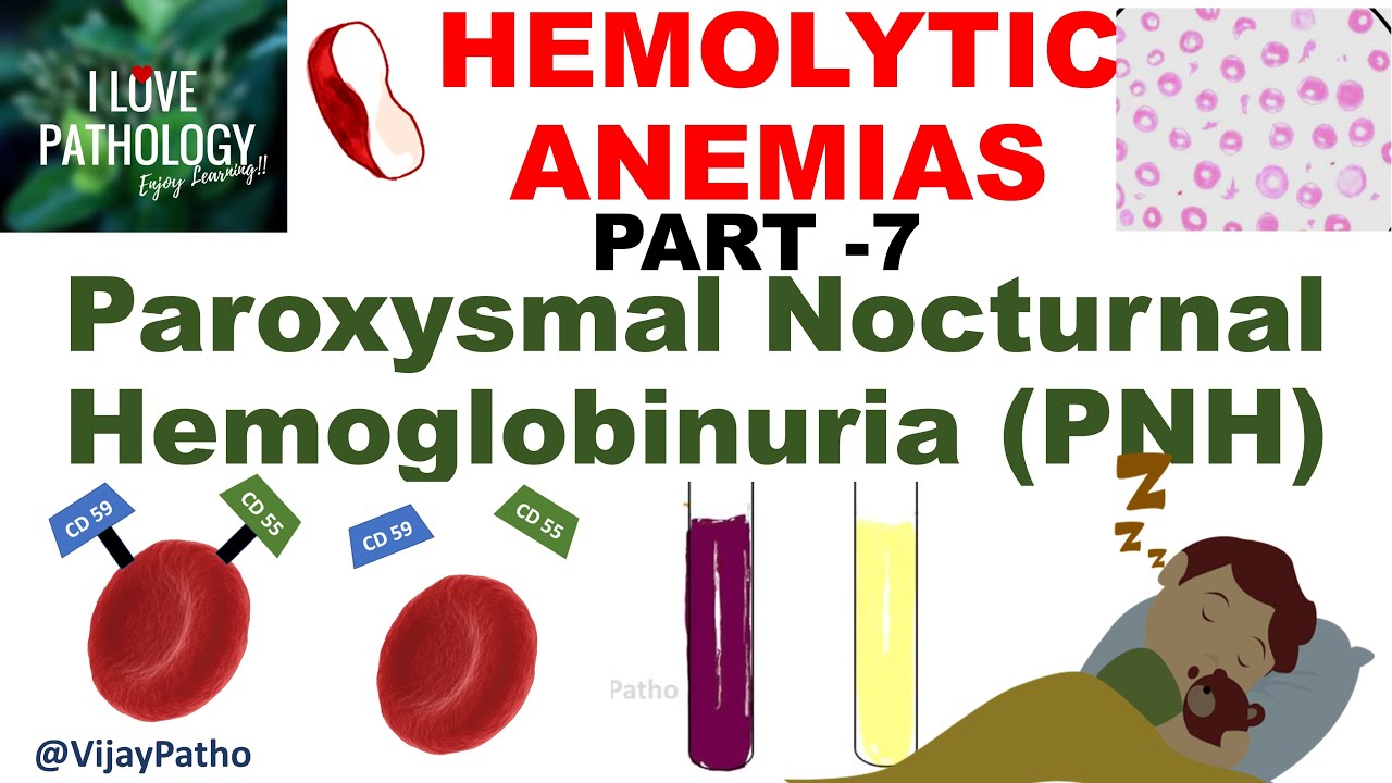 Hemolytic Anemias- Part 7: Paroxysmal nocturnal hemoglobinuria (PNH)