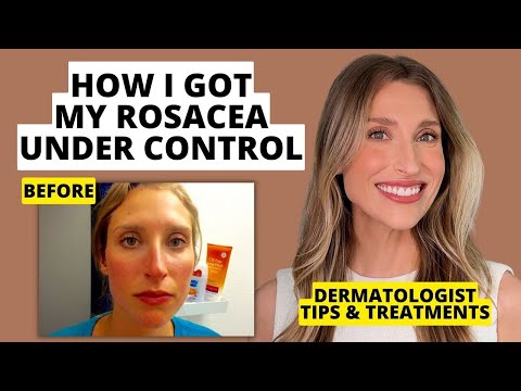 My Rosacea Journey: Dermatologist Shares Skincare &...