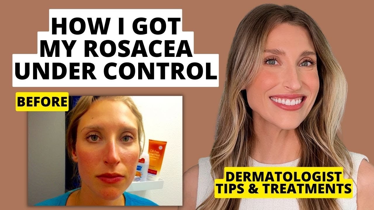 My Rosacea Journey: Dermatologist Shares Skincare & Treatments That Work! | Dr. Sam Ellis