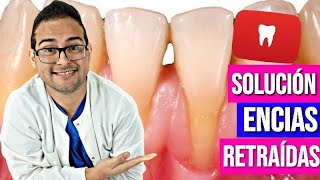 ENCÍAS RETRAÍDAS 👄 Solución VERDADERA😮 a la RETRACCIÓN GINGIVAL ✔️ (2018)