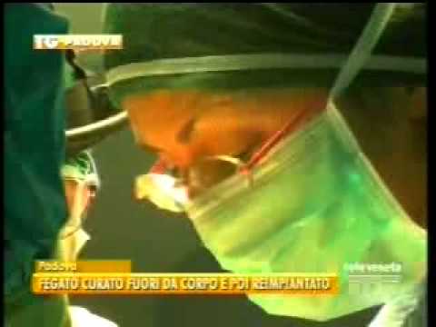 Padova: Fegato curato "al banco" e reimpiantato
