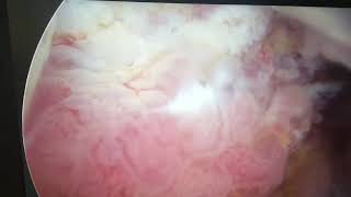 Resezione Endoscopica Tumore Vescicale ,Turb