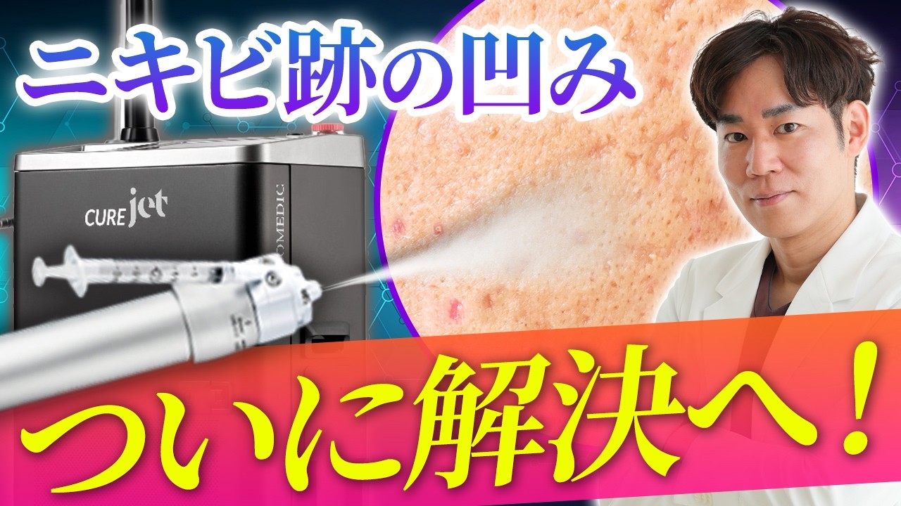 ニキビ跡クレーターに効く治療