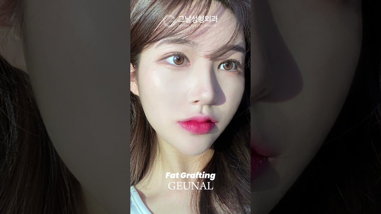 6 Area Wajah yang Bikin Kelihatan Lelah & Tua 😱 (Solusi Fat Grafting)