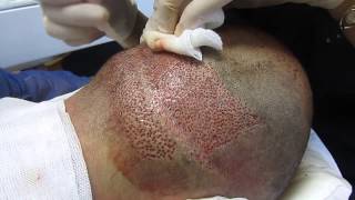 FUT Strip scars: Restoration with Advanced FUE _ Dr.Anastasios Vekris