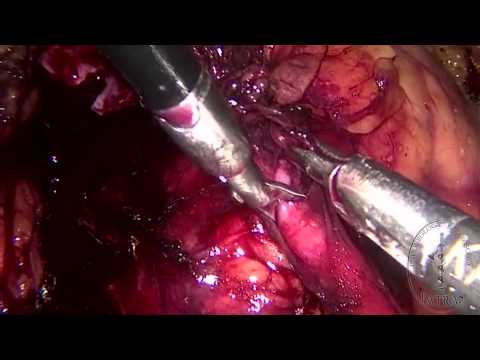 Laparoscopic Pyeloplasty