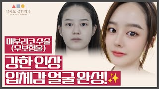 입체감 없던 얼굴에 매부리코 20대 여성  매부리코 수술로 청순한 인상 완성!_[삼사오 성형외과]