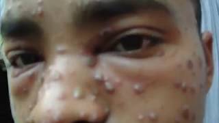 Chickenpox Video