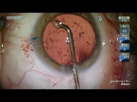 High Myope Toric IOL