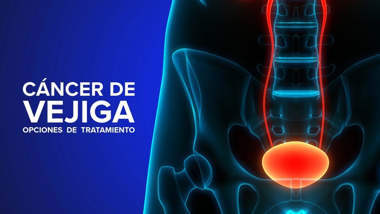 Thumbnail preview of Cáncer de Vejiga - Una experta explica opciones de tratamiento