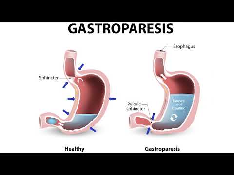 Ehlers Danlos Syndromes in GI Patients