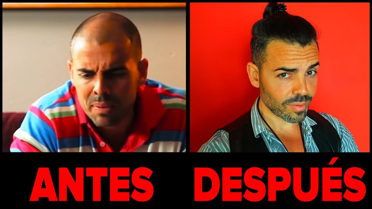 Cómo hacer que te crezca el pelo rápido... ¡incluso si eres calvo! | 5 Remedios para la alopecia