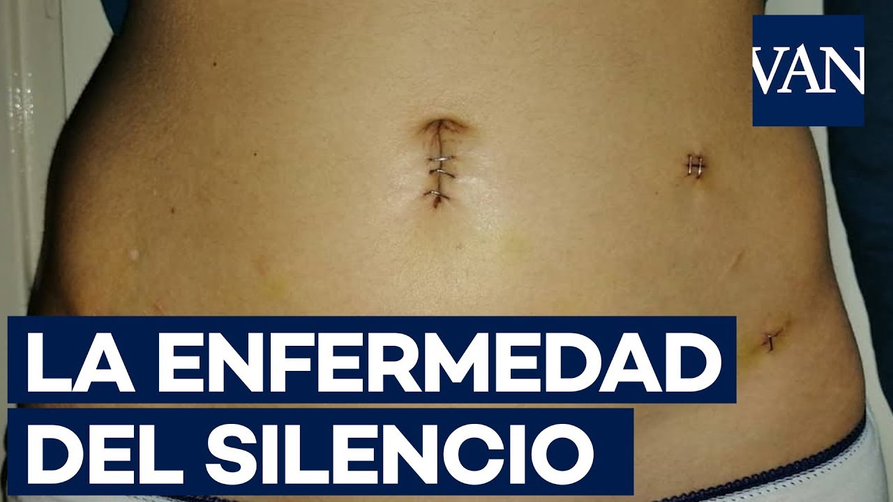 Watch Así es vivir con endometriosis, la enfermedad silenciosa que afecta a 1 de cada 10 mujeres Now Así es vivir con endometriosis, la enfermedad silenciosa que afecta a 1 de cada 10 mujeres