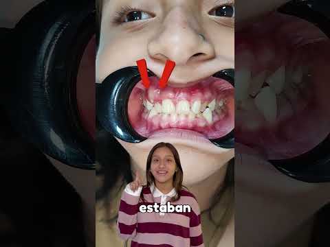 Video testimonial de un paciente con expansión maxilar